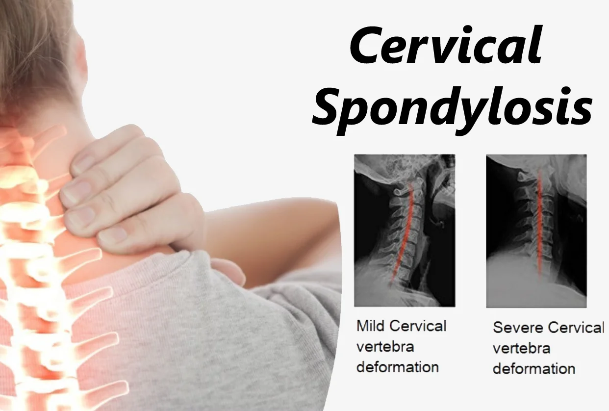 Cervical Spondylisis